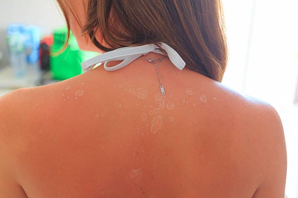 UV sun damage skin photoaging effects wrinkles dark spots from cumulative exposure