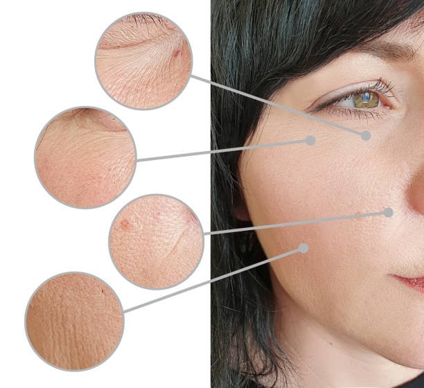 skin texture improvement with retinoid use showing reduced fine lines and smoother complexion Retinol vs Retinoid