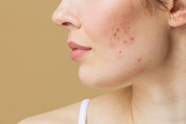 Common acne mistakes including harsh scrubs and excessive product use