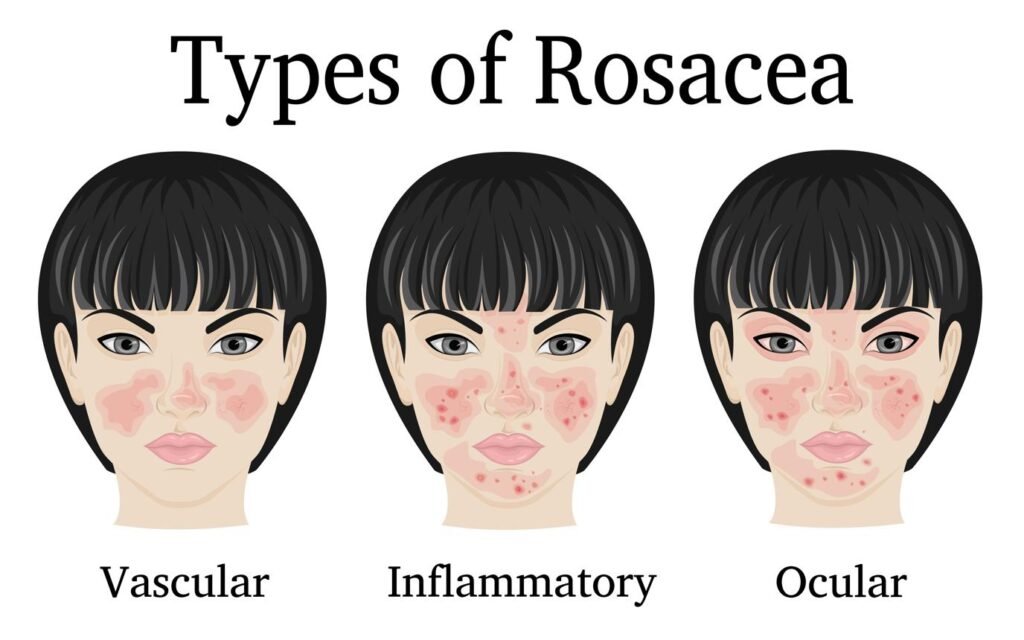 Illustration showing areas of the face commonly affected by rosacea