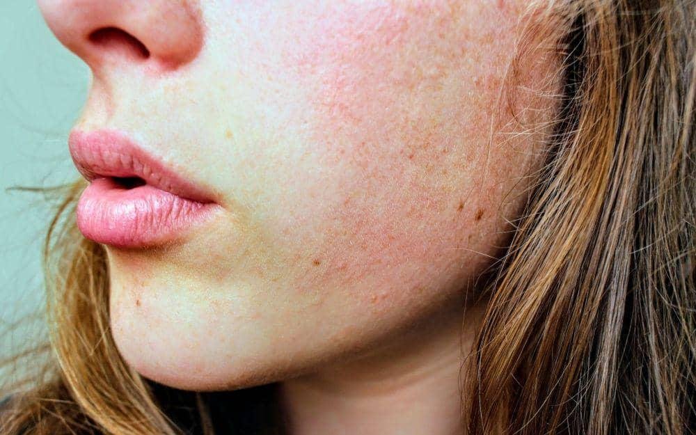 Examples of harsh skincare products hat can trigger rosacea flare-ups