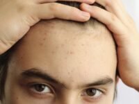 Skincare Routine for Teenagers With Acne: Simple, Affordable, and Actually Effective