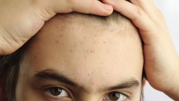Skincare Routine for Teenagers With Acne: Simple, Affordable, and Actually Effective