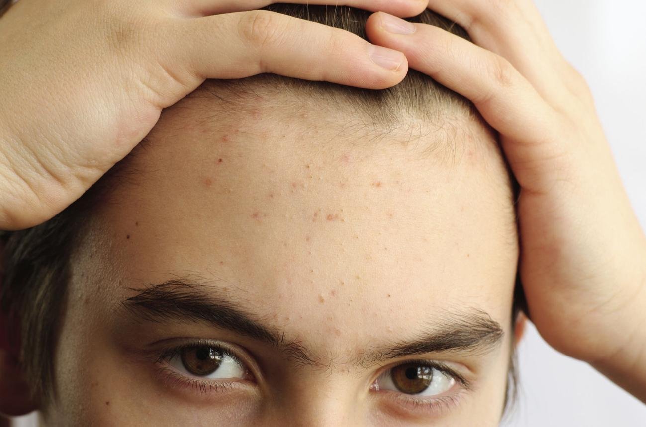 Skincare Routine for Teenagers With Acne: Simple, Affordable, and Actually Effective
