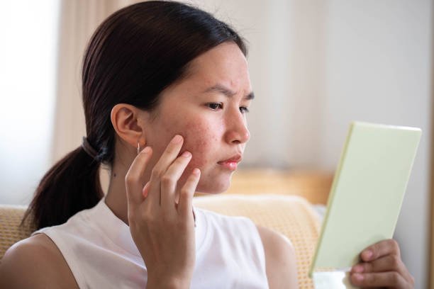 Targeted spot treatment applied directly to an acne pimple