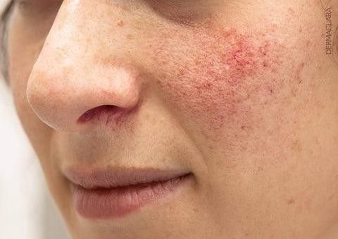  skin barrier Damaged from overusing skincare products
