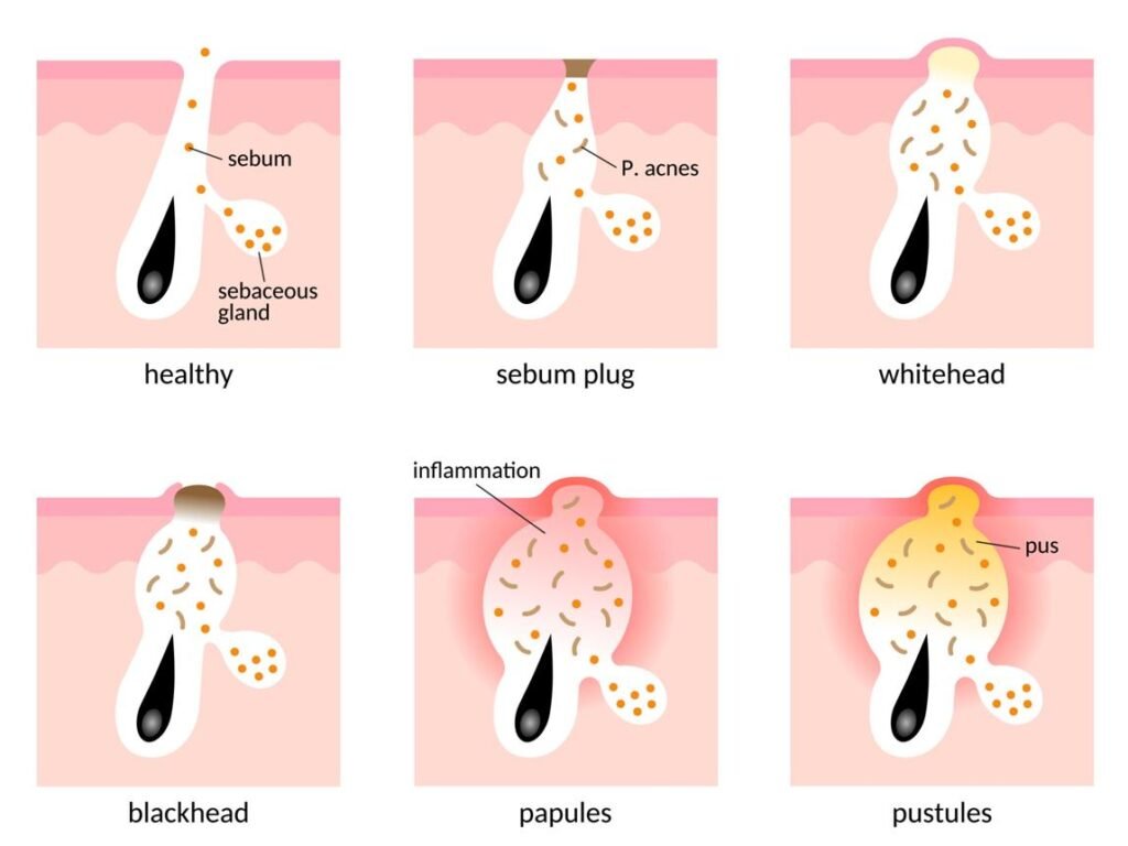 Diagram showing how excess oil and bacteria lead to acne formation