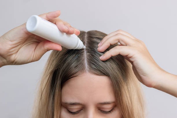 Scalp buildup caused by excessive hair product use