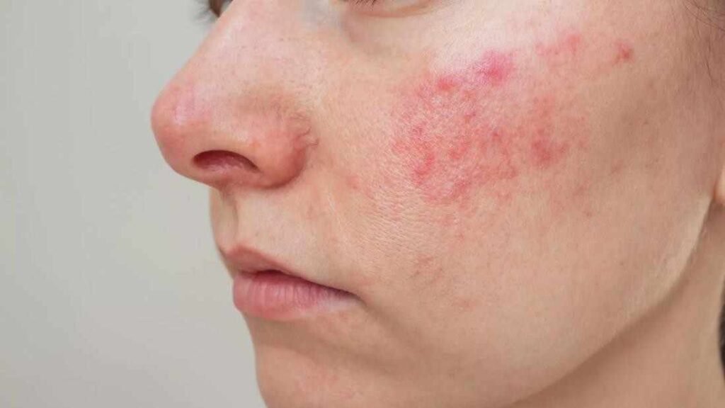 Red irritated skin caused by too many active ingredients