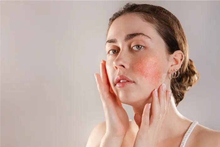 Visible signs of skin barrier damage including redness dryness and irritation