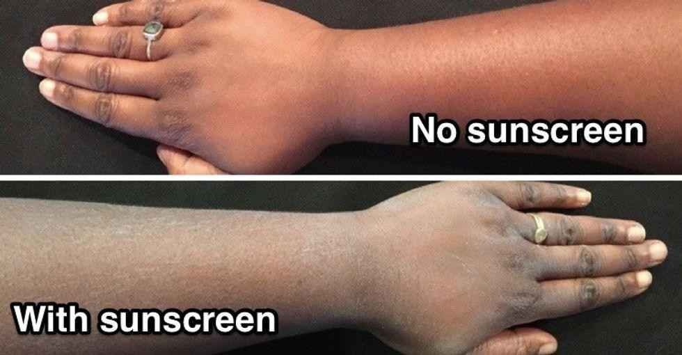 White cast left by sunscreen on brown skin