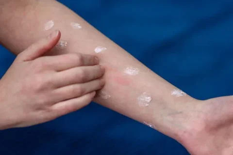 Ways to Prevent Recurring and Treat Sunburns  Skin: Dermatologist Approved